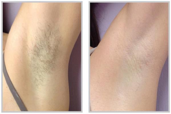 Armpit hair removal - nova derm institute