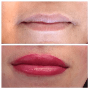 Lip augmentation - Nova Derm Institute