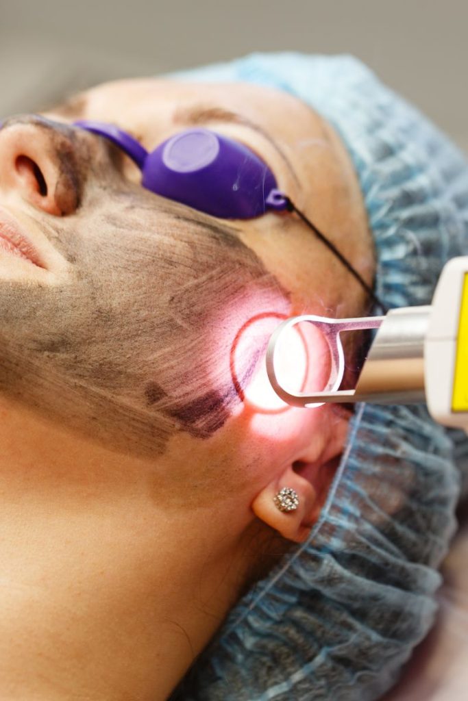 Carbon Laser peel leesburg va