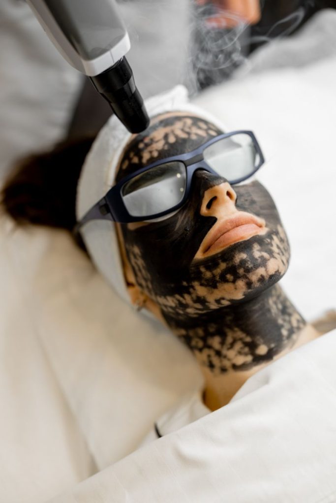 Carbon Laser peel leesburg virginia Nova Derm