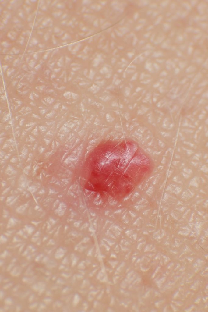 Cautery treatment Leesburg Virginia