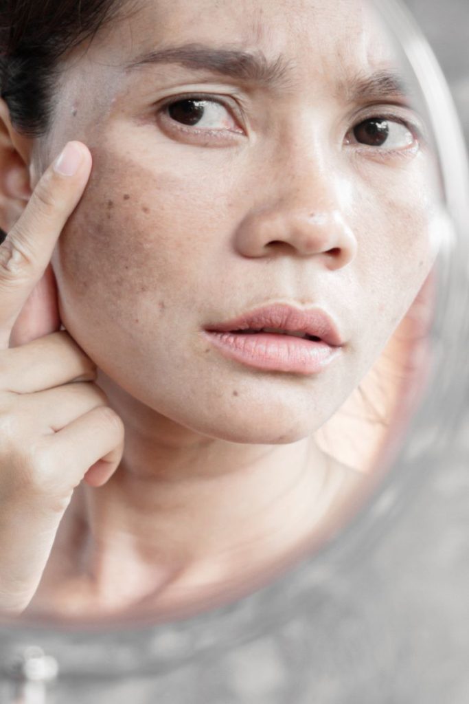 Melasma Treatment Leesburg VA
