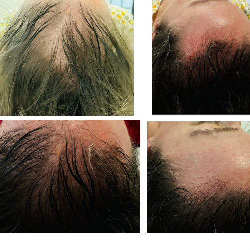 Hair Rejuvenation in Leesburg VA