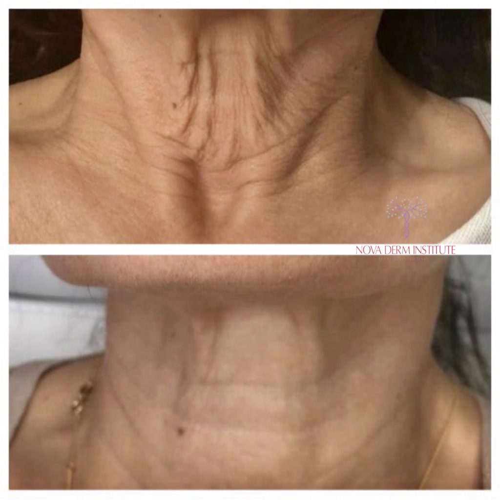Neck tightening in Leesburg VA