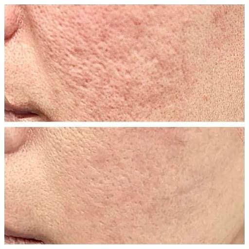 Microneedling in Leesburg VA