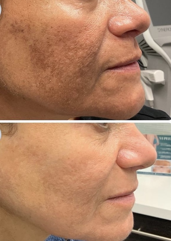Melasma Peel in Leesburg VA