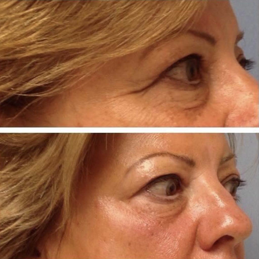 Opus RF neck resurfacing before and after at Nova Derm Institute