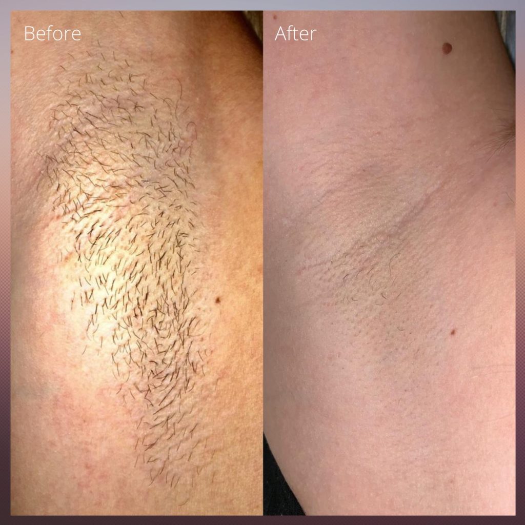 Laser Hair Removal Underarms Leesburg VA