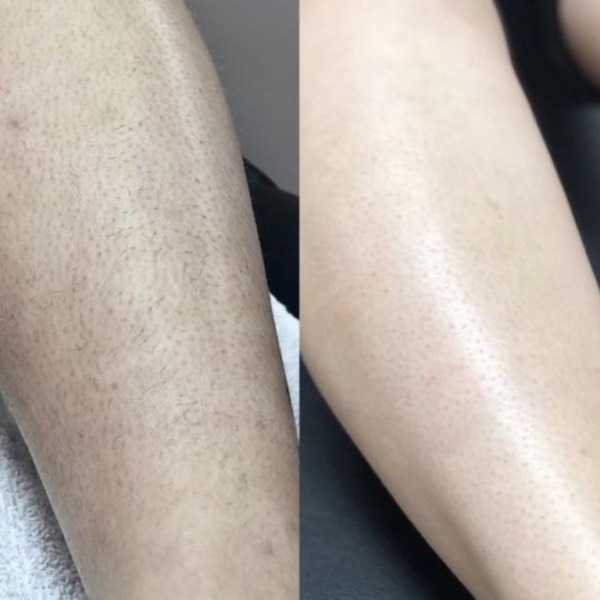 Laser hair removal Legs in Leesburg VA