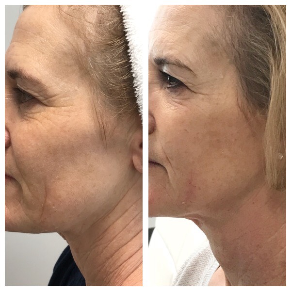 Opus fractional RF treatment for facial texture in Leesburg VA