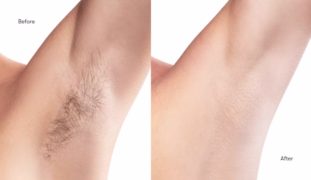 laser hair removal before and after leesburg VA