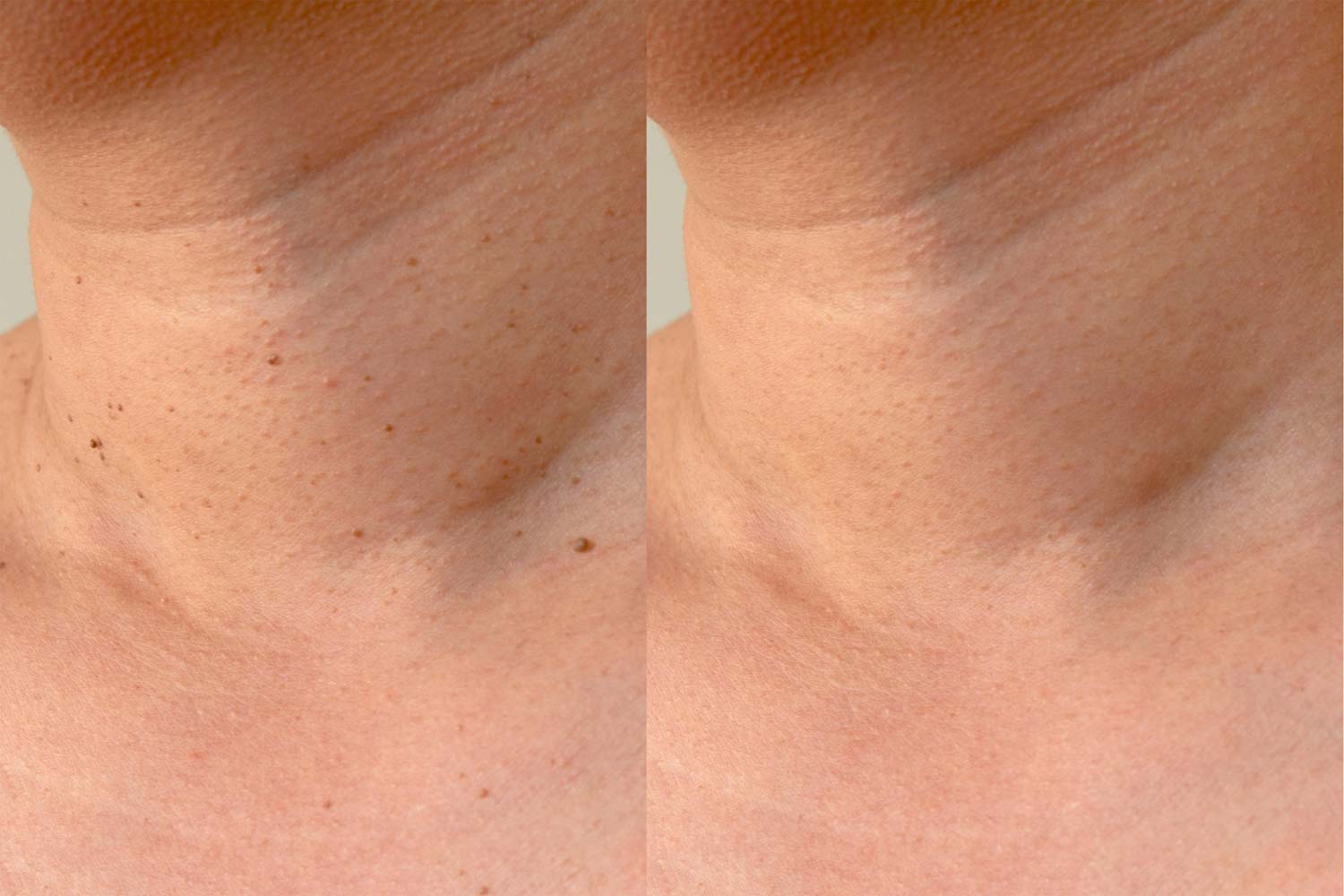Cautery for Skin Tags Leesburg VA
