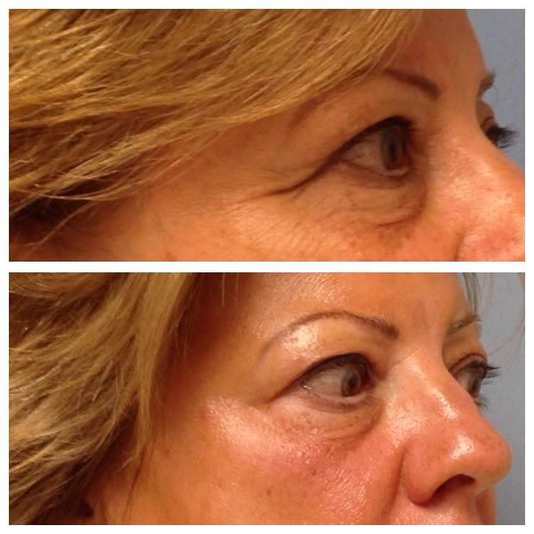 Opus RF skin tightening Leesburg VA before and after results at Nova Derm Institute